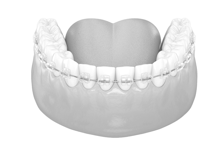 Translucent (Ceramic) Braces